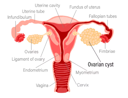Ovarian Water Cyst